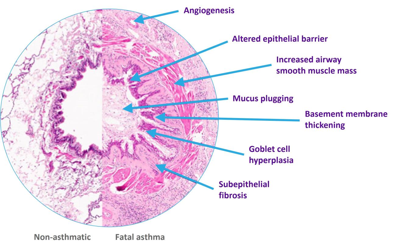 The Airway Epithelium Plays A Key Role In Driving Airway Remodelling In ...